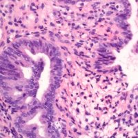 adenocarcinoma_in_ situ1